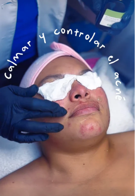 LIMPIEZA ANTI-ACNE