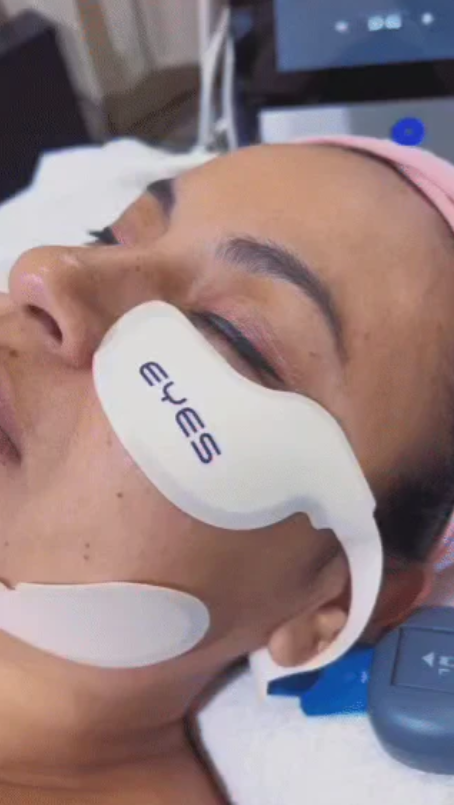 Máquina de estiramiento facial EMS RF